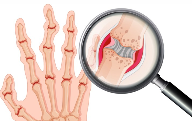 Viêm khớp dạng thấp: Nguyên nhân, triệu chứng, chẩn đoán và điều trị